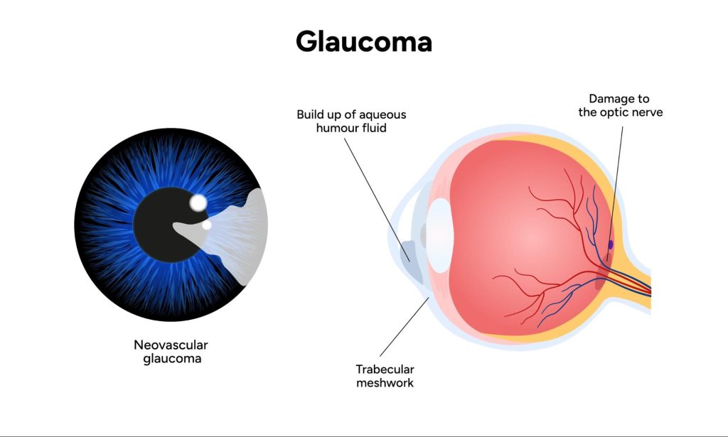 Educational diagram of glaucoma showing fluid build-up, trabecular meshwork issue, and optic nerve damage, a clear view of glaucoma definition and effects.