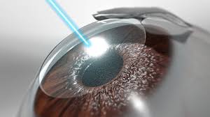 3D illustration of laser eye correction representing LASIK vs refractive lens exchange