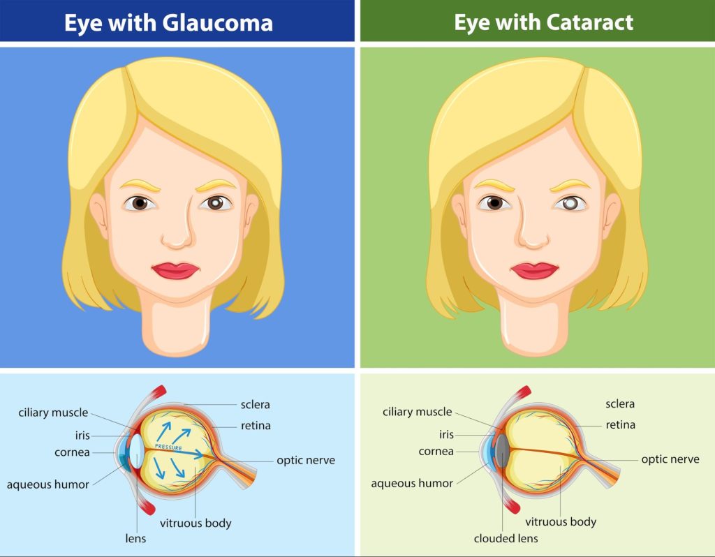 Medical illustration showing glaucoma eyes with increased eye pressure and optic nerve damage, compared to cataract eyes with a clouded lens, helps explain glaucoma definition visually.