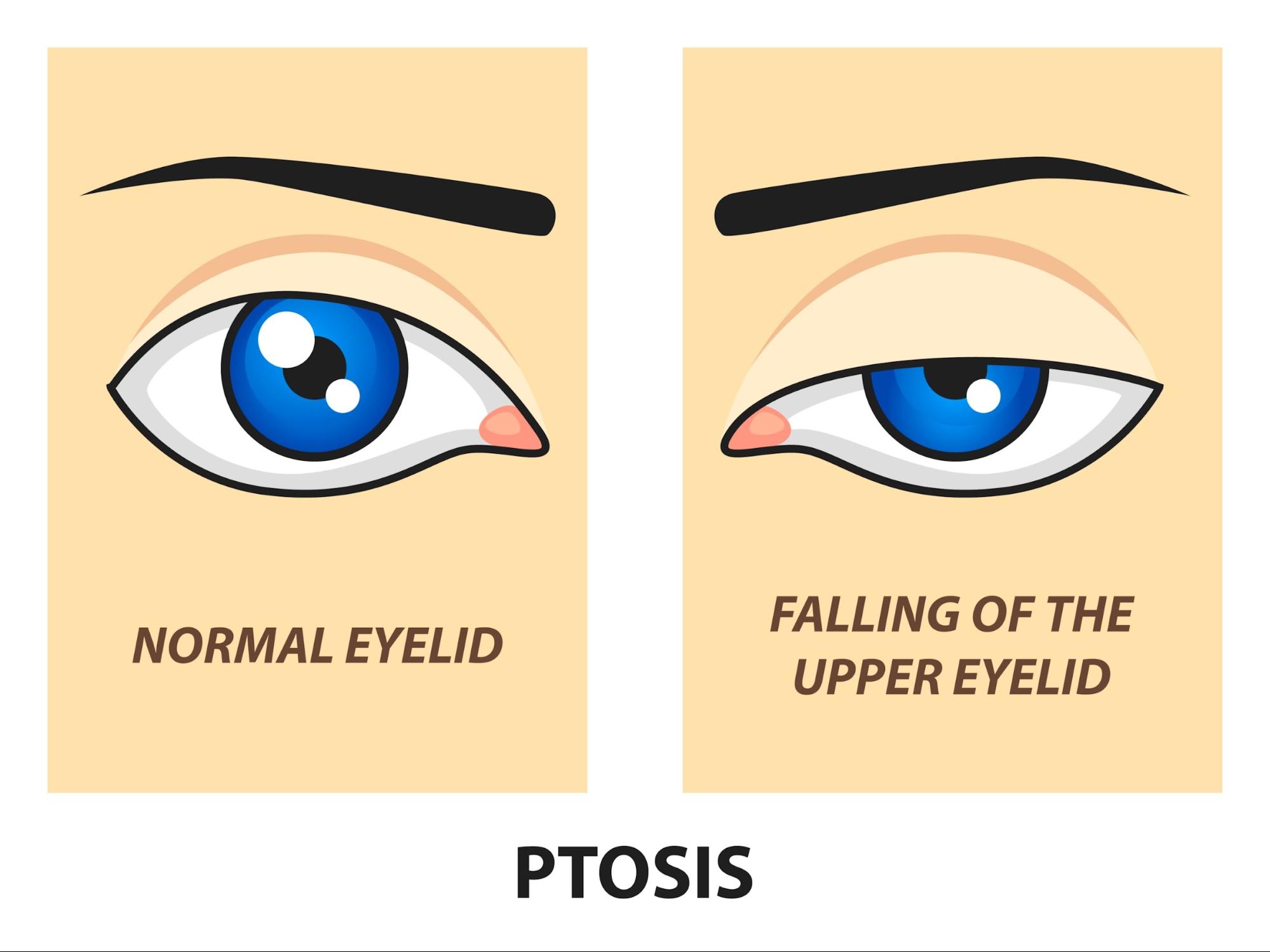Medical illustration showing ptosis of eyelid, comparing a normal eyelid and an eyelid with ptosis, highlighting ptosis meaning and its visual impact.