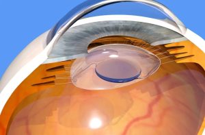 Close-up illustration of intraocular lens placement showing refractive lens exchange procedure