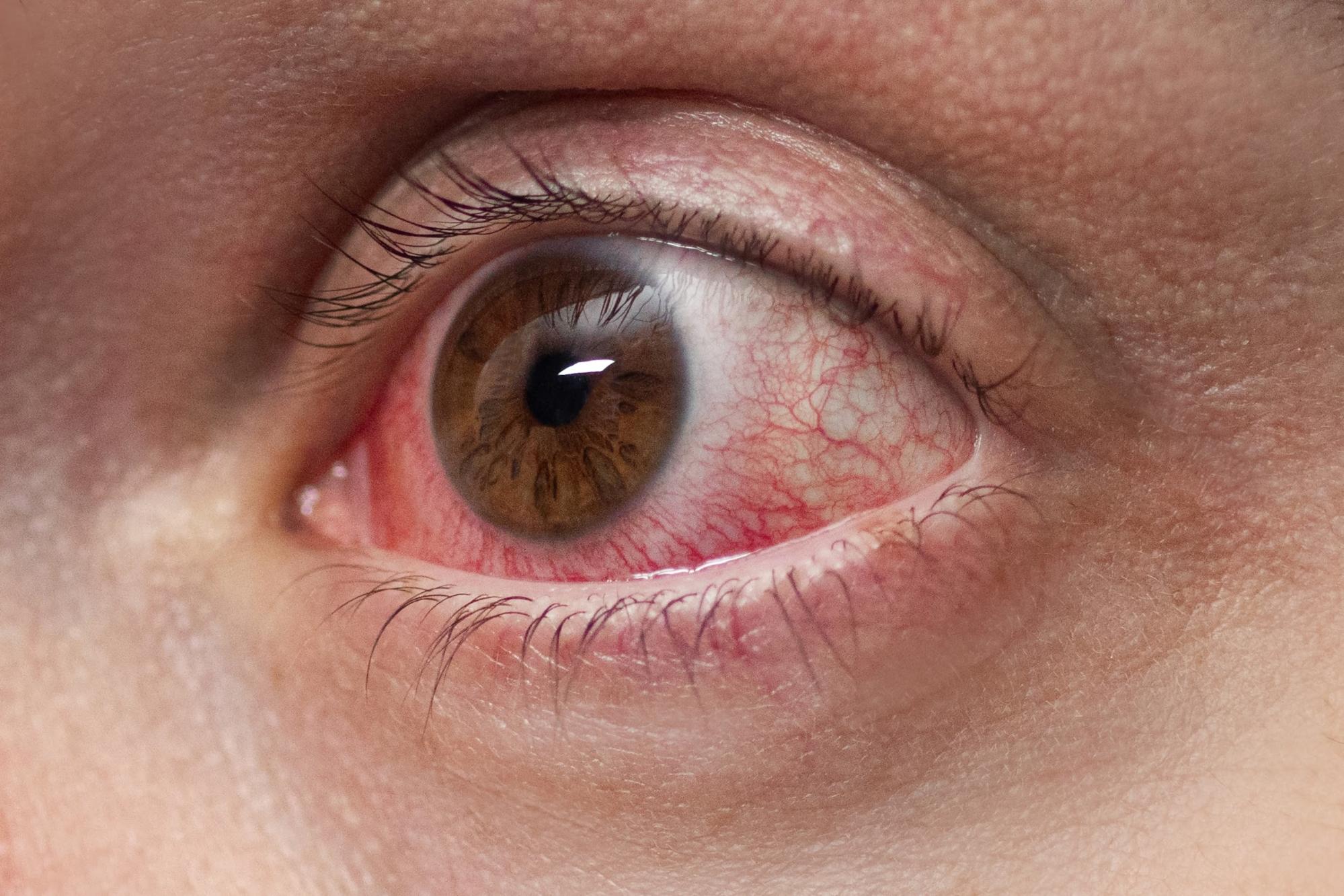 Detailed close-up of an eye with visible redness and veins, showing typical pink eye symptoms.