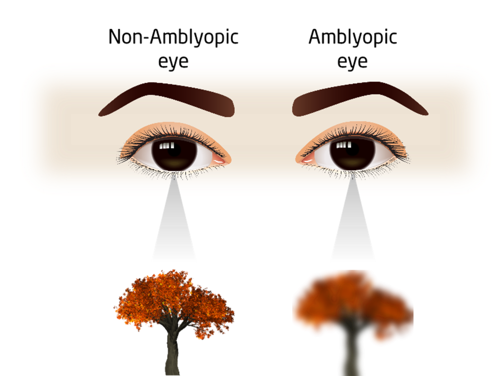 An illustration compares a non-amblyopic eye seeing a sharp tree versus an amblyopic eye seeing the same tree blurry