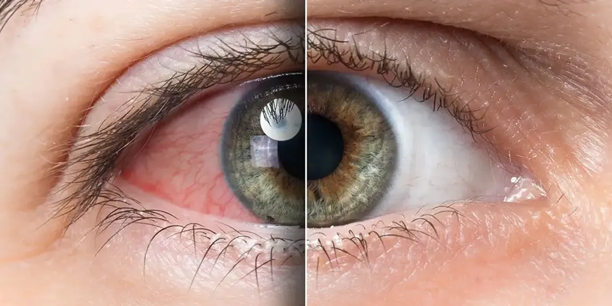Close-up comparison of a red, irritated eye versus a healthy, clear eye, illustrating symptoms of dry eye or eye inflammation