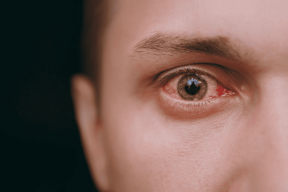 A close-up of a man's red, irritated eye