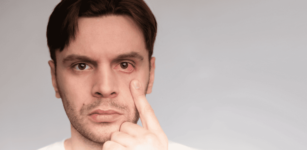 A man pointing to his red, irritated eye