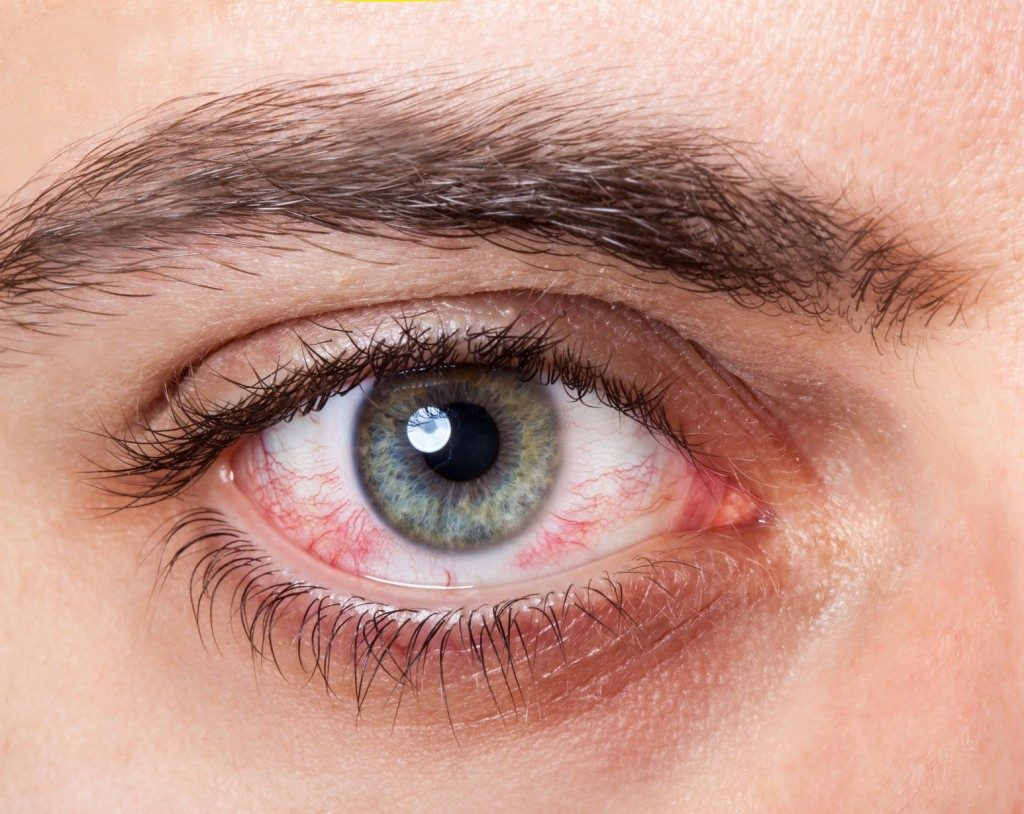 A close-up of a red, irritated eye with visible blood vessels across the sclera