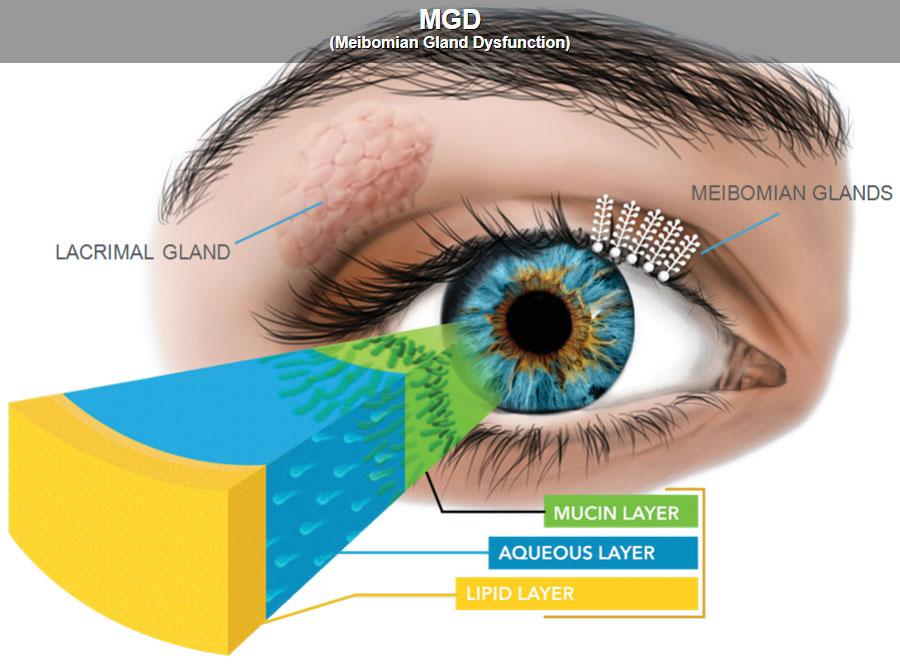 A blue eye with the lacrimal gland, meibomian glands, and expanded tear film layers labeled to show meibomian gland dysfunction
