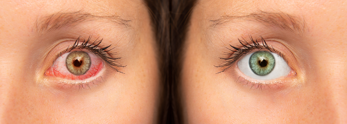 Side-by-side comparison of a red, irritated eye and a healthy, clear eye
