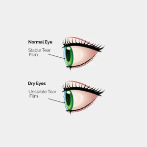 An illustration comparing a normal eye with a stable tear film to a dry eye with an unstable tear film