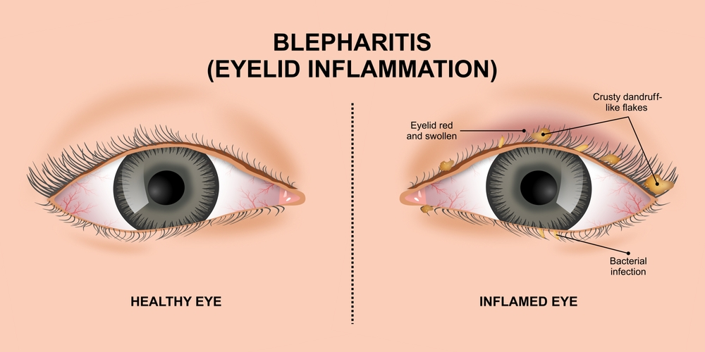 Side-by-side comparison of a healthy eye vs. an inflamed eye with blepharitis showing crusty flakes, redness, and bacterial infection